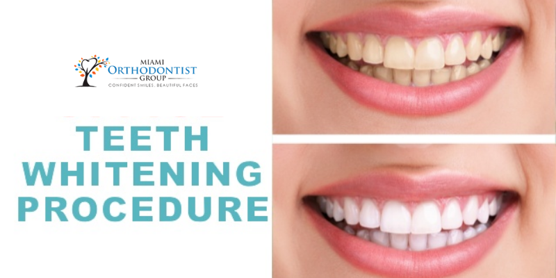 Things You Should Know About The Different Types of Teeth Whitening Procedures