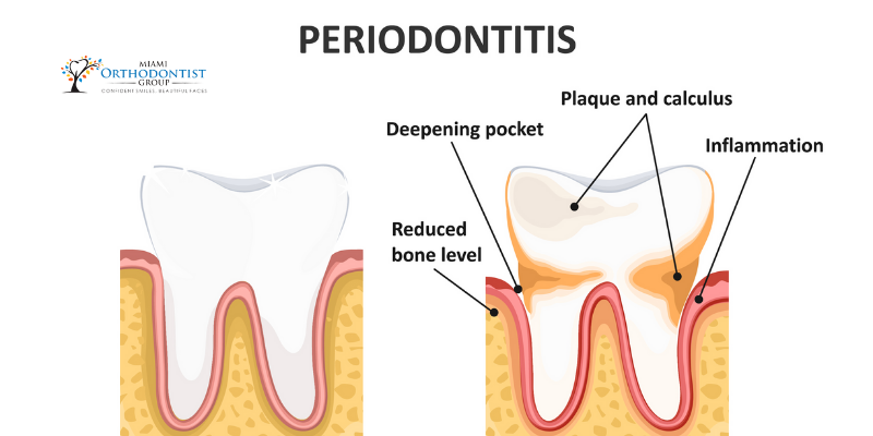 What Are Periodontal Disease Symptoms? - Miami Orthodontist Group