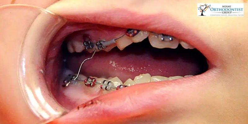 Doctors Remove Braces Wire from Woman's Intestine 10 Years After  Orthodontics Removal