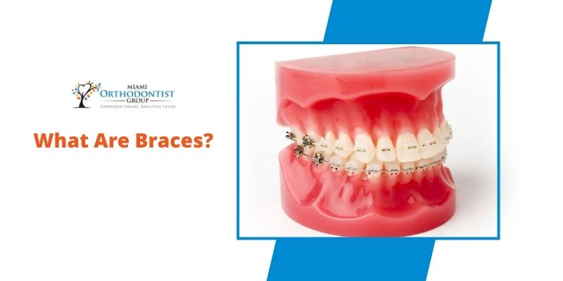 How-to-Use-Rubber-Bands-On-Braces-Miami