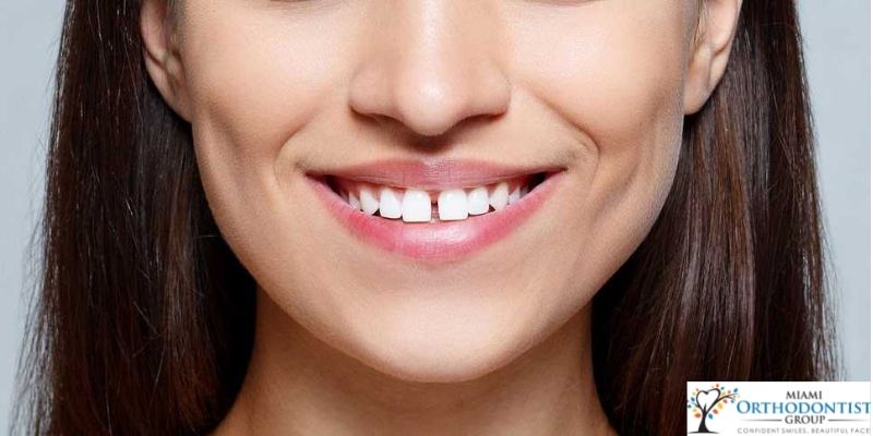 teeth gaps issues