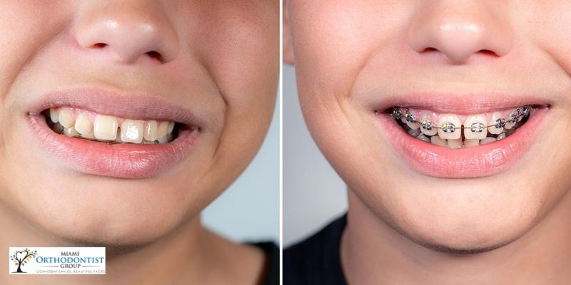 Overbite Teeth Treatment