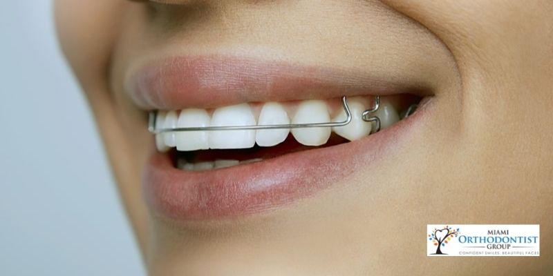 Wear Retainers After The Invisalign Treatment