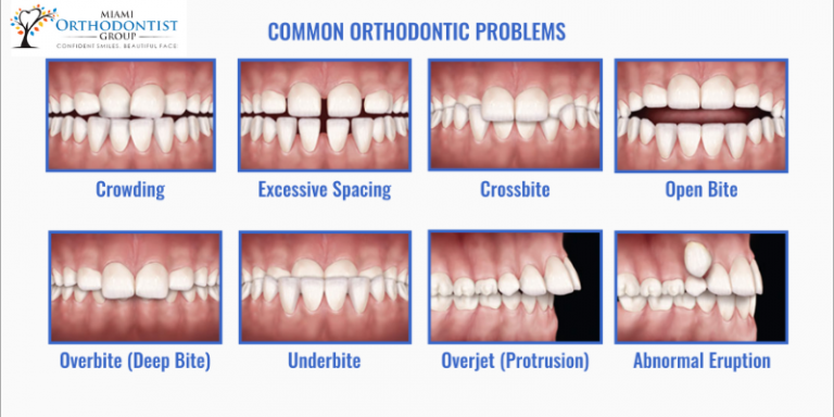 Different Types Of Bite Alignment And Treatment - Miami Orthodontist Group