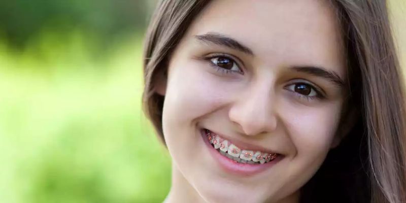 The Benefits of Clear Braces