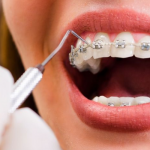 Retainers After Braces_ Use and Cleaning Guidelines