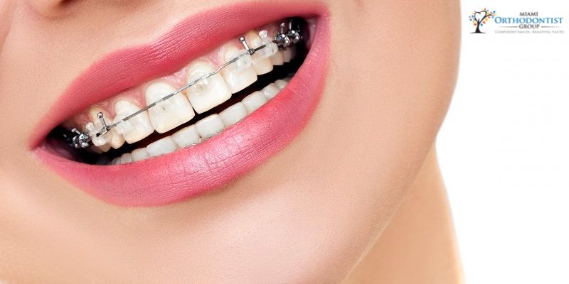 Success Story Two_ Using Clear Aligners to Close Gaps