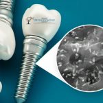 Nanotechnology in Dental Implants