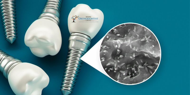 Nanotechnology in Dental Implants