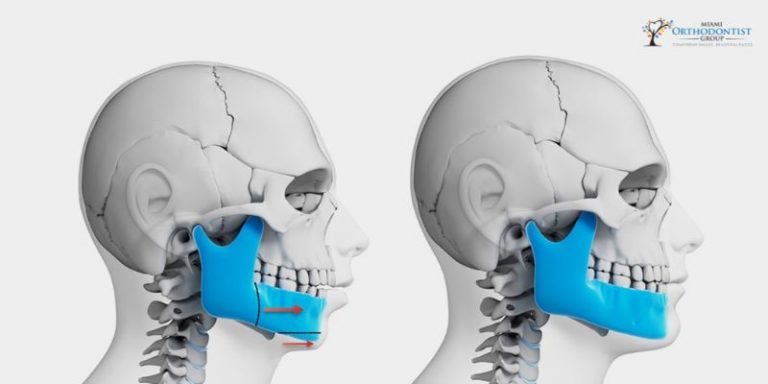 How Can Orthognathic Surgery Treat Sleep Apnea?