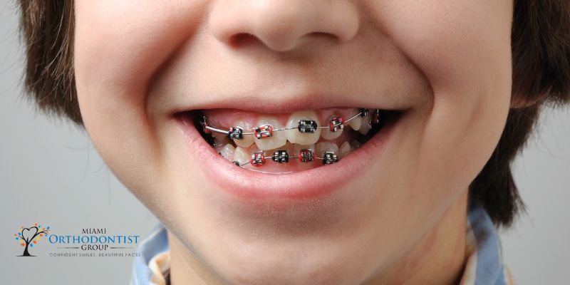 The Purpose of Orthodontic Elastics: Straightening Beyond Braces