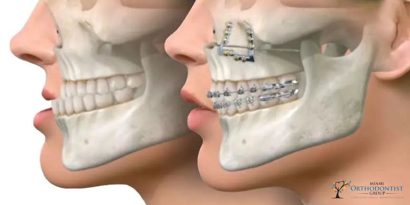 Addressing Skeletal Abnormalities_ The Core of Orthognathic Surgery