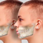 Enhancing Oral Health_ The Role of Orthognathic Surgery in Treating Bite Issues