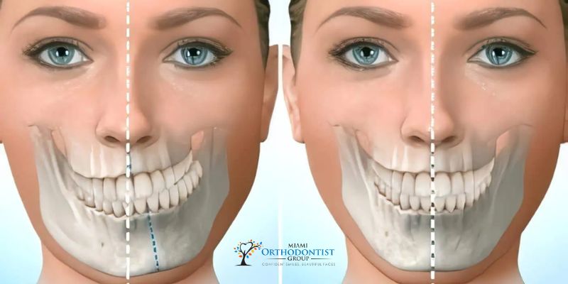 Causes of Jaw Misalignment
