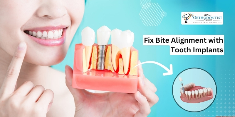 Fix Bite Alignment with Tooth Implants